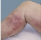 Diagnosi e complicanze delle vene varicose