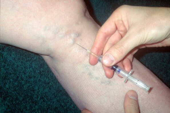 scleroterapia per vene varicose