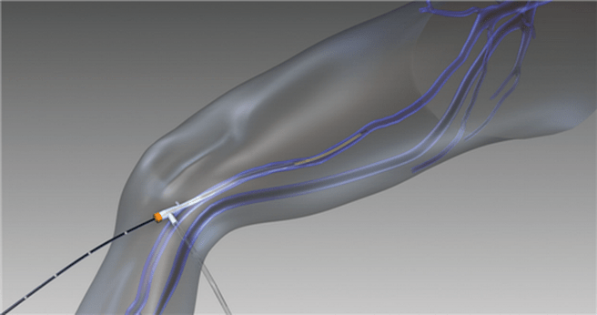 Obliterazione con radiofrequenza delle vene varicose