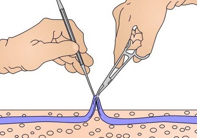 stripping per vene varicose