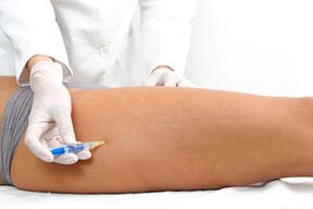 la scleroterapia come metodo di trattamento delle vene varicose