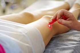 trattamento laser per vene varicose