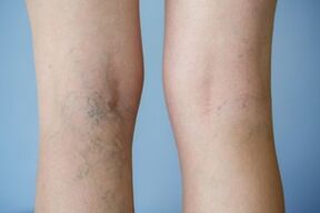 vene varicose sulle gambe