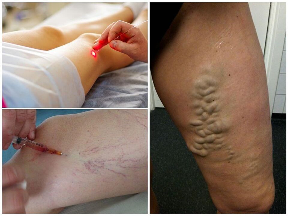 Metodi di trattamento non chirurgico delle vene varicose delle gambe