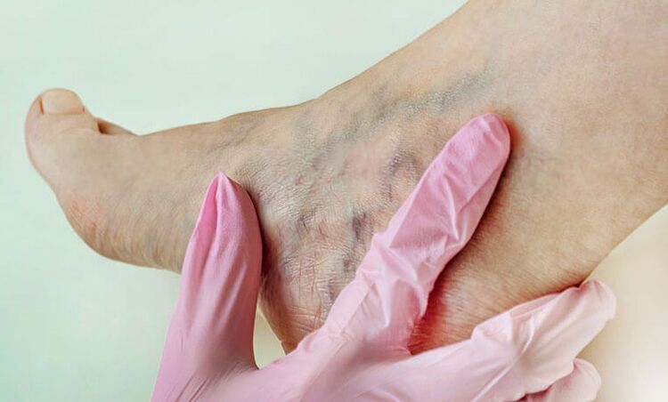 vene varicose sulle gambe